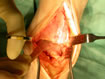 the spur being removed to allow identification of the actual level of the joint.