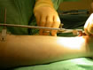 the alignment jig applied to the tibia prior to cutting a space for the joint.
