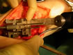 5 mm of bone being removed from the tibia guided by the jig .