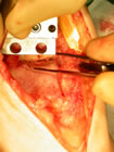 the gap produced by removing the tibial bone. the talus(1) remains to be prepared.
