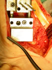 the jig applied to remove 4mm of bone from the talus.