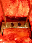 the talar jig for fine cutting the front(1) and back (2) faces of the talus.