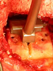 the bone impactor to ensure correct size of the groove.the bone impactor to ensure correct size of the groove.
