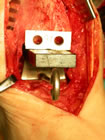 the trial talus(1), spacing block(2) and woods' jig(3) in situ in readiness for final preparation of the tibia.