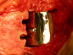 the talar component in situ and holes in the tibia ready for the tibial component.