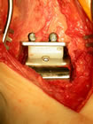 the finished ankle replacement with talus (1) and tibia(2) resurfaced and a uhmwpe meniscus(3) inbetween.